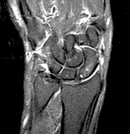 MRI Wrist Scan (AI Enhanced)